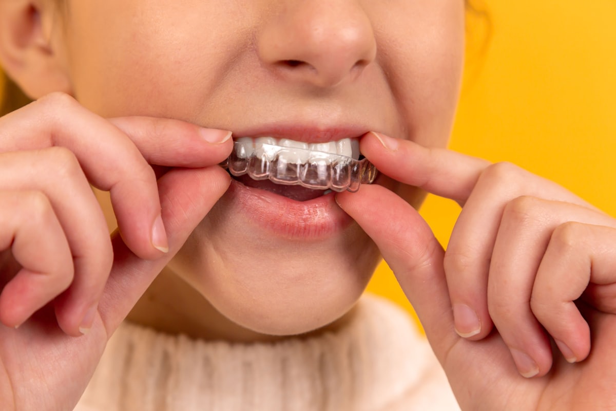 Patient fitting a clear orthodontic aligner over their teeth